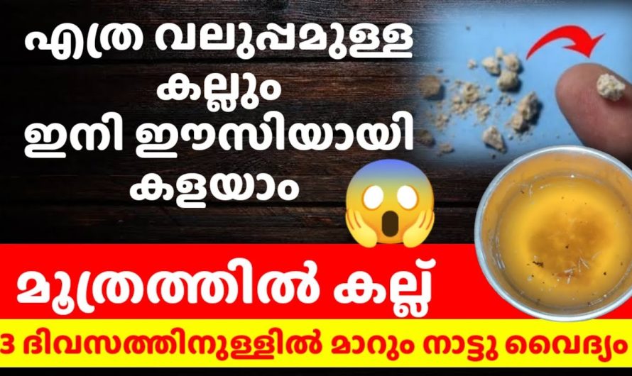 ഈയൊരു പ്രയോഗം ചെയ്താൽ മൂത്രത്തിലൂടെ തെറിച്ചു പോകും, മൂത്രത്തിൽ കല്ല് എത്ര വലുപ്പമുള്ളതാണെങ്കിലും