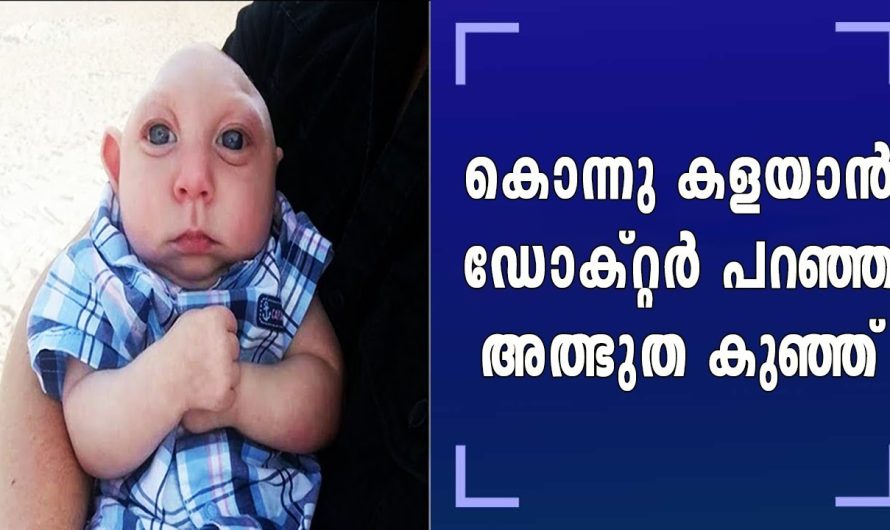 ശാസ്ത്രം ഞെട്ടി ഈ കുഞ്ഞിനെ കണ്ട്, ഇന്നും അത്ഭുതമാണ്, തലച്ചോർ ഇല്ലാതെ ജനിച്ച കുഞ്ഞു