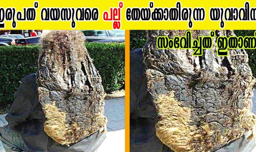 പല്ല് ഇരുപത് വയസുവരെ തേയ്ക്കാതിരുന്ന യുവാവിന് സംഭവിച്ചത് ഇങ്ങനേയും മനുഷ്യരുണ്ടെന്ന് വിശ്വസിക്കില്ല!